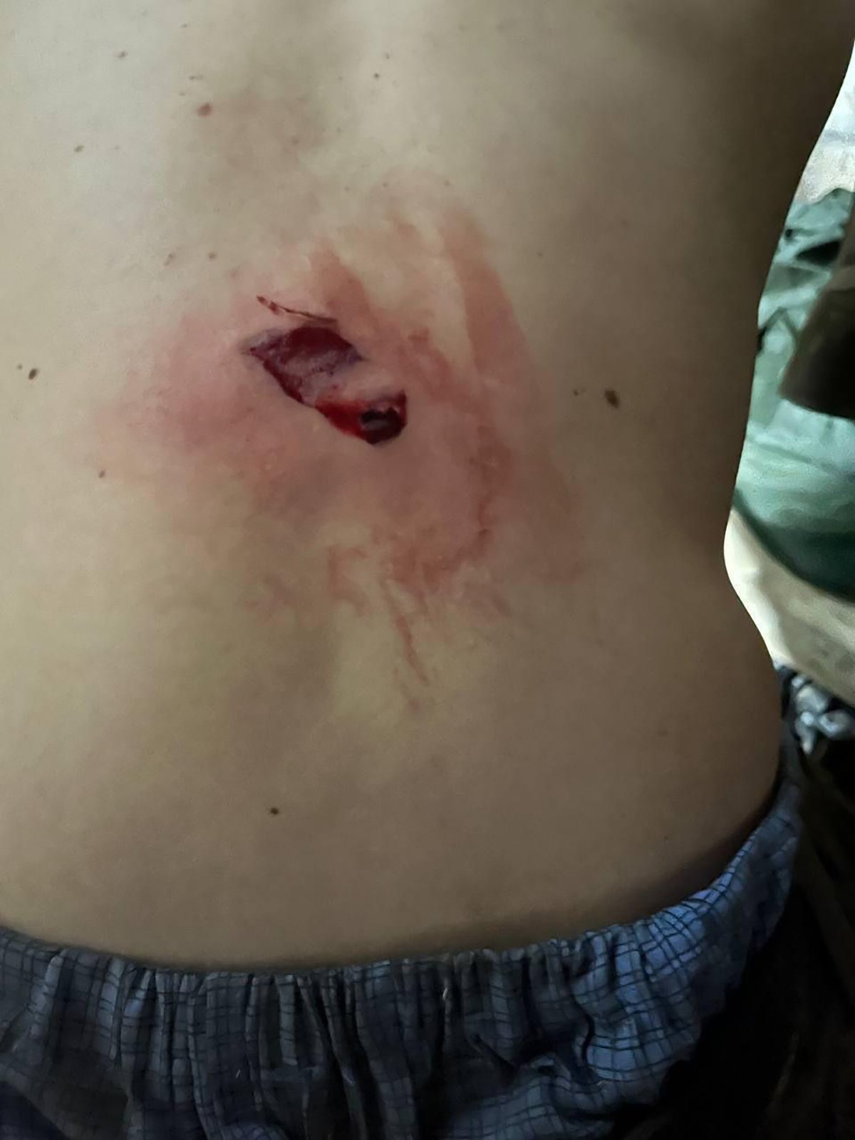 Осколочное ранение бойца из взвода Александра. Фото: личный архив Александра